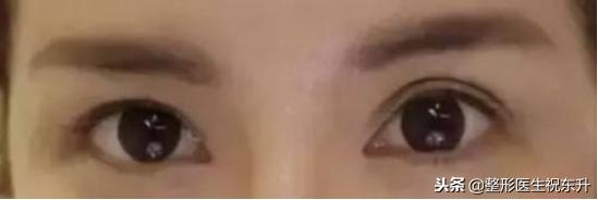 割双眼皮后怎样可以尽快完全恢复,割的双眼皮很不自然要怎么修复呢