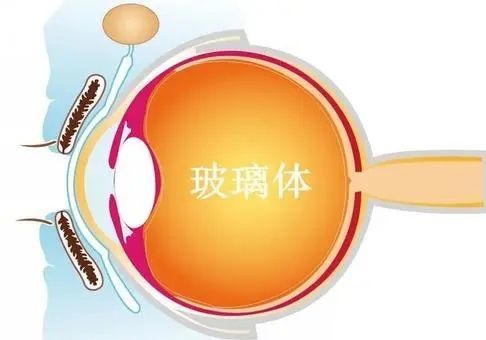 眼前有黑影之飞蚊症