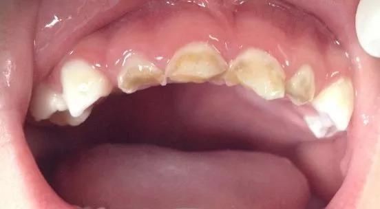 牙齿小洞不补下一句是什么,牙齿小洞不补大洞吃苦的意思