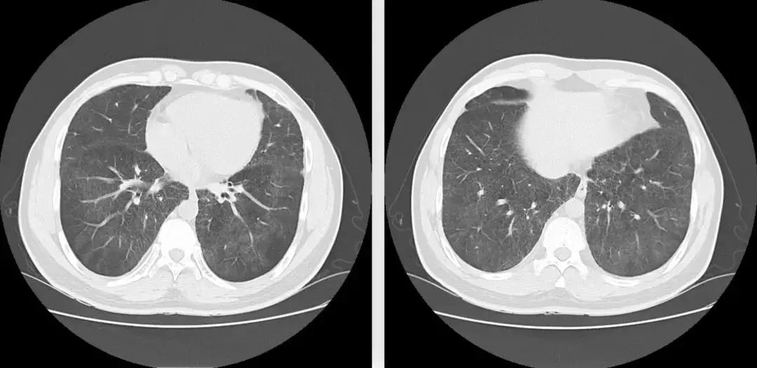 青年男性肺炎过后一直咳嗽怎么办,潜伏结核感染咳嗽咳痰