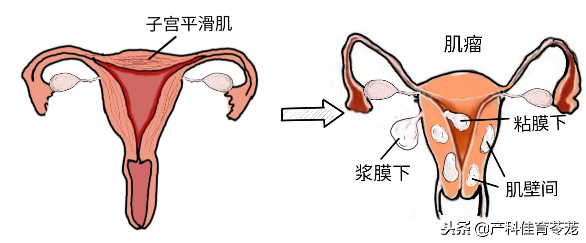 肌瘤和腺肌瘤的关系,肌瘤与腺肌瘤的区别