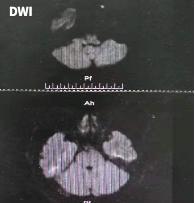 哪些药物会导致震颤,震颤病怎么回事