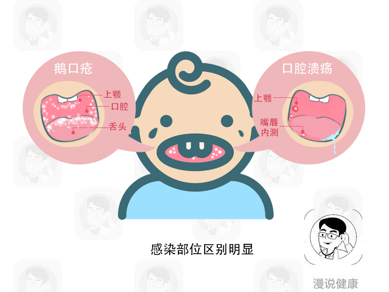 婴儿口腔溃疡和鹅口疮的区别,鹅口疮是皮肤还是口腔病