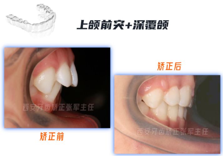 牙齿矫正雁塔区,矫正牙齿拔掉4颗智齿