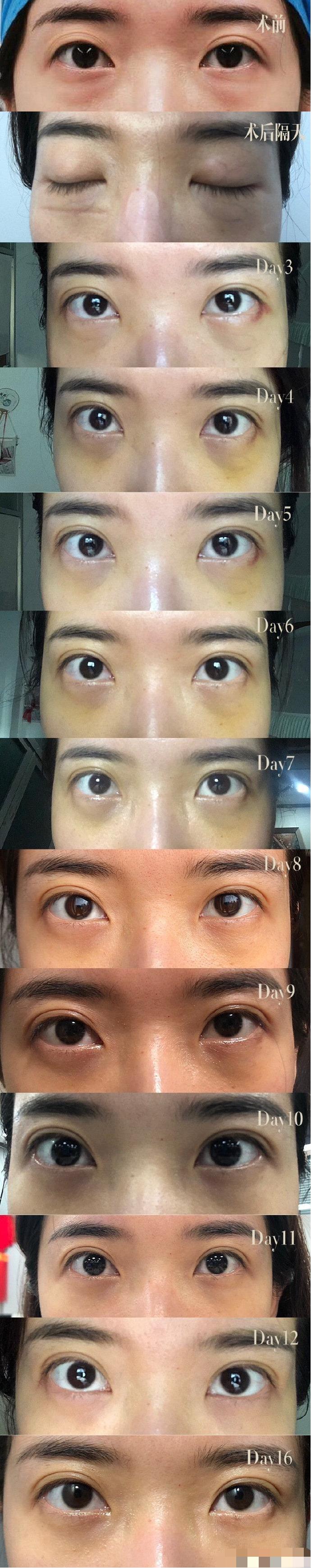 切眼袋后的疤痕增生多久能够恢复,为什么做了眼袋手术后悔的人很多