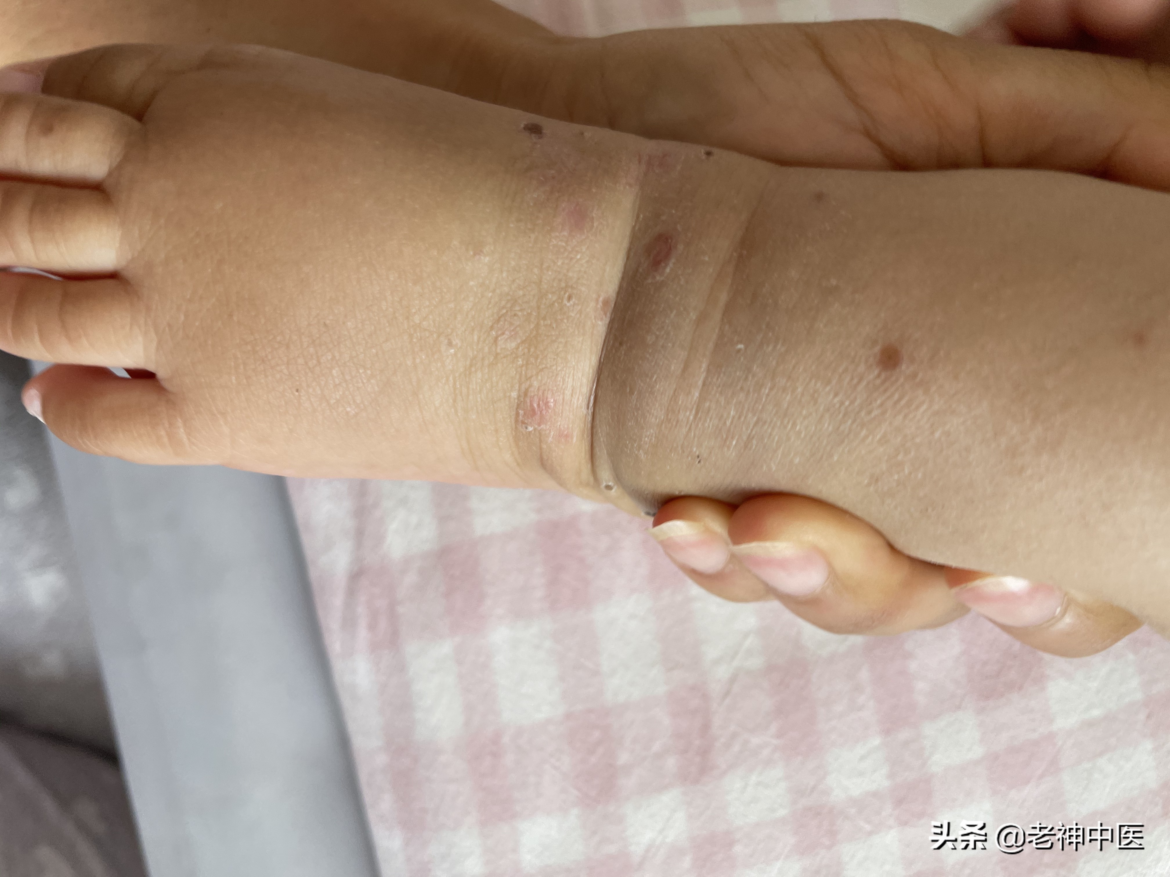 成人手足口病传染,儿童手足口病怎么传染的