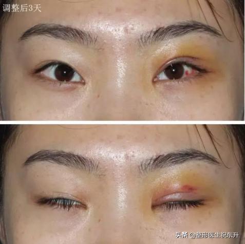 矫正上睑下垂的手术没有效果,上睑下垂矫正手术后听到嘣的一声
