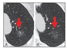 肺CT报告中的肺结节GGO是什么东西？到底是不是癌？