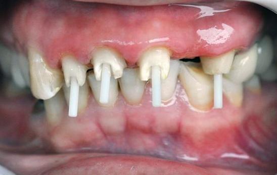 牙齿残根不疼不痒有必要拔除吗,牙齿残根可以不治疗吗