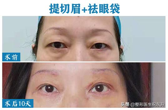 上睑松弛有什么解决办法,上睑皮肤松弛解决的方式有哪些