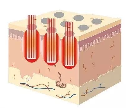 点阵激光每次间隔时间大有效果吗,点阵激光真实经历