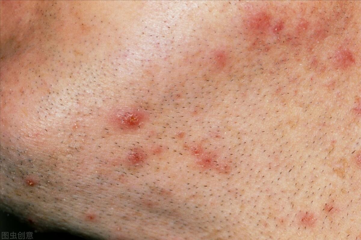 毛囊炎久治不愈可能是糖尿病吗,毛囊炎久治不愈说明有癌症