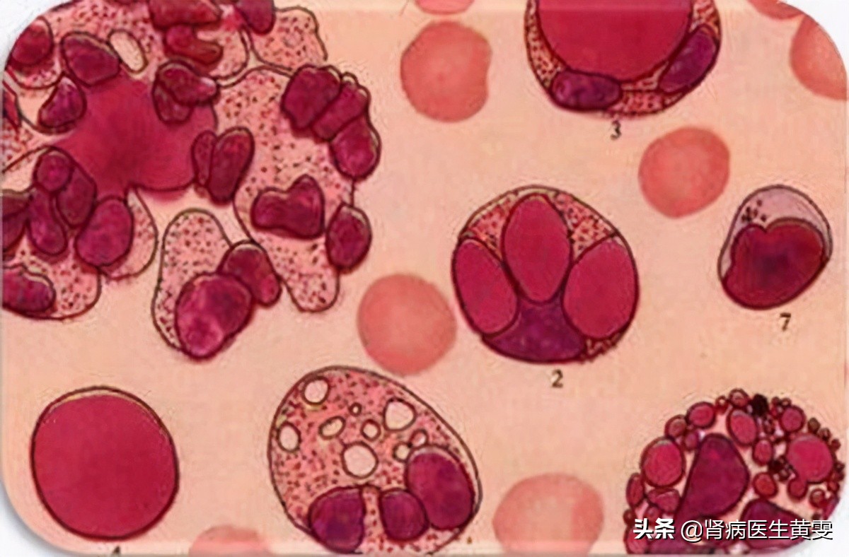 治疗肾炎的象数疗法,中医治疗肾炎的临床路径