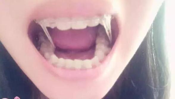 戴全牙套,初学者戴牙套的感受