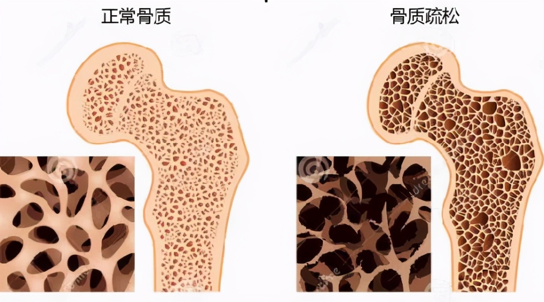 世界骨质疏松日｜骨质疏松，别不把它当回事