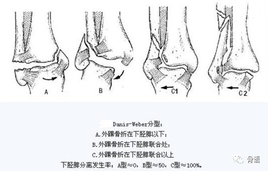 70岁老人骨质疏松性骨折怎么治疗,骨质疏松性骨折的治疗