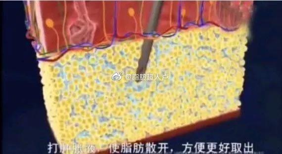 吸脂后腰部有积液抽一次,腰部吸脂一个月还有积液