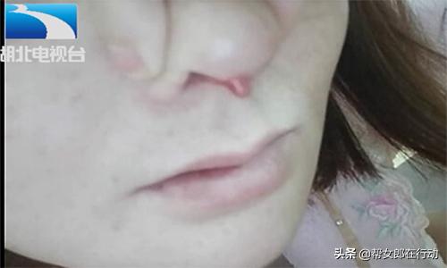 假体耳软骨隆鼻六天伤口流脓,花费近三万元隆鼻鼻子竟然变歪了