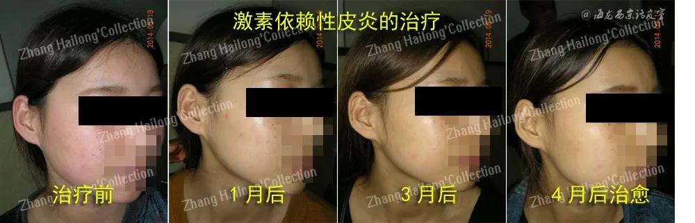 激素依赖性皮炎可以用什么护肤品,护肤要重视肌肤的免疫力