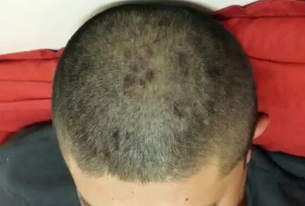 头皮和脸上起疙瘩有脓包怎么回事,头皮上总出油长有疙瘩或脓包