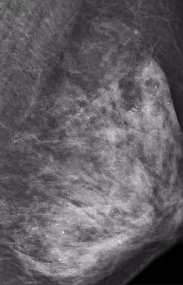 乳房按摩按到胸内满是“沙粒”!乳房保养,在家做到这3点就行了