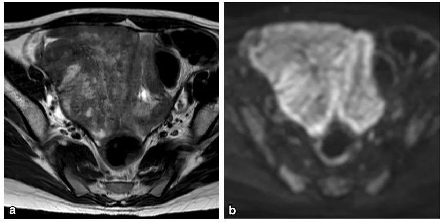 卵巢实性为主肿瘤，这13种你都想到了吗？