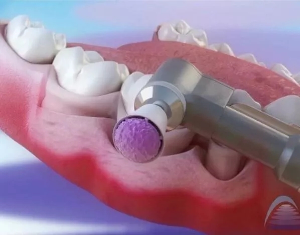 超声波洁牙加上喷砂和抛光全过程,超声波洁牙需要抛光喷砂吗