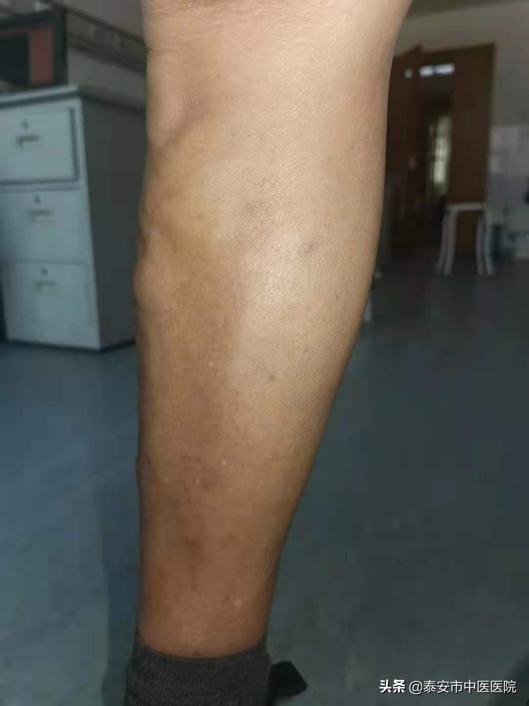 中医治疗下肢静脉曲张消除蚯蚓腿,微创闭合大腿根治静脉曲张过程