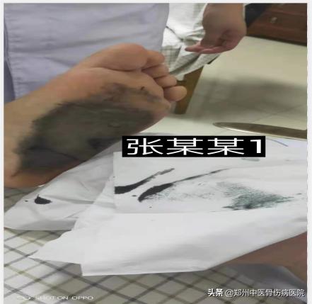 李氏砭法刮痧培训班在我院举办,铜砭虎符耳部刮痧手法视频教学