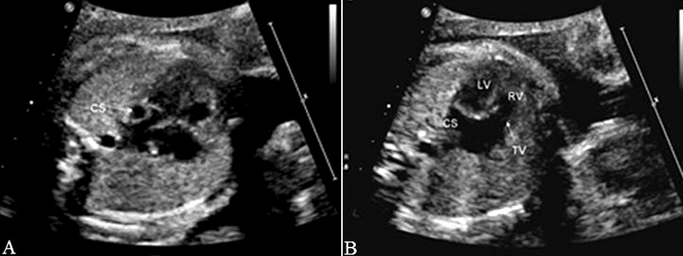 胎儿心脏发育异常微小室间隔缺损,胎儿心脏缺损1.3毫米严重吗