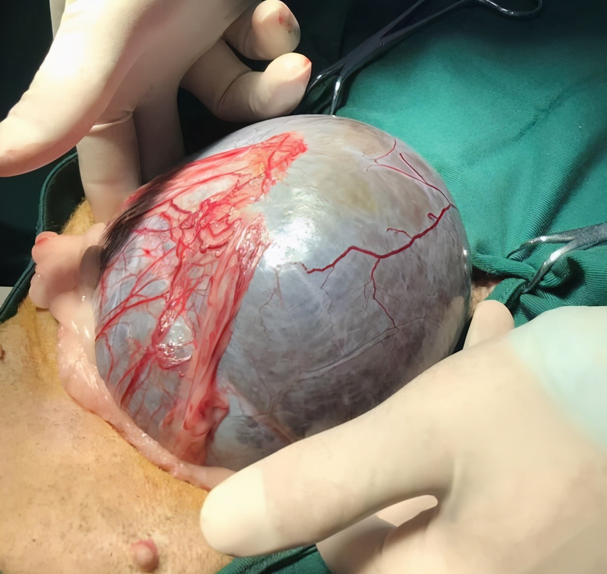 狗狗皮下脂肪瘤的特征,狗狗肿瘤长得快一定是恶性的吗