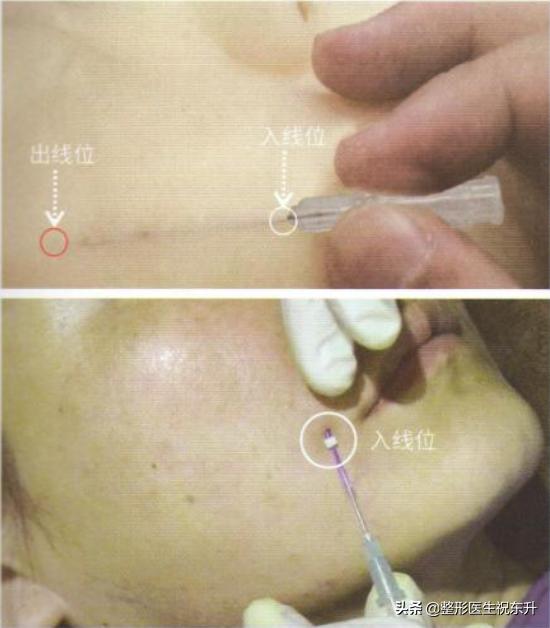 做完线雕半个月脸还是肿痛，是正常现象吗?知道的谈一谈