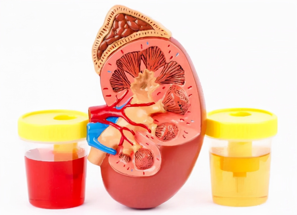 iga肾病中医能治疗吗,iga肾病中医治疗