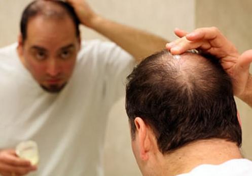 脱发真的有办法再生发吗,脱发严重了有什么办法治疗