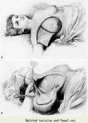 若有专家还在用这种方式治疗乳腺癌，不要犹豫，立马举报他