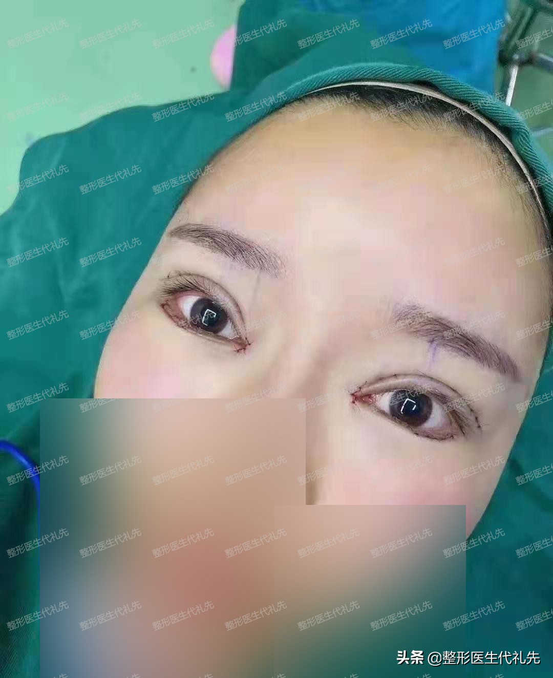 聊一聊眼睛手术,双眼皮怎么选看完你就知道了