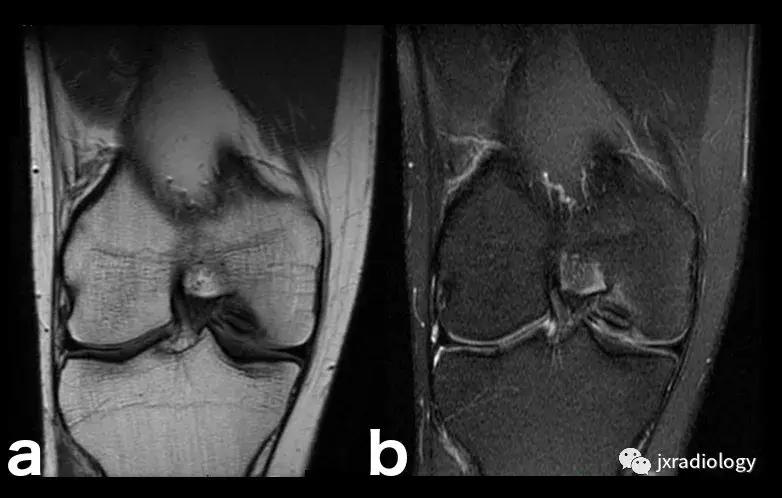 磁共振天天诊断骨髓水肿，但您知道原因吗？