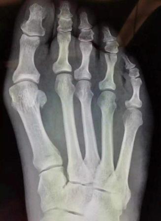 拇外翻大脚趾死皮厚,大脚趾拇外翻怎么处理