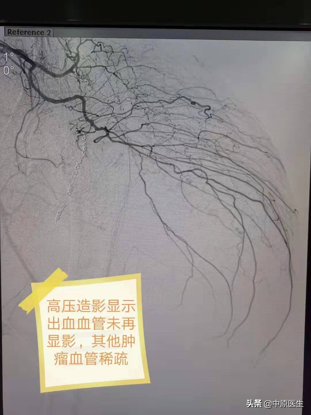 老人得肝癌的保守治疗方法,肝癌晚期75岁治疗成功案例