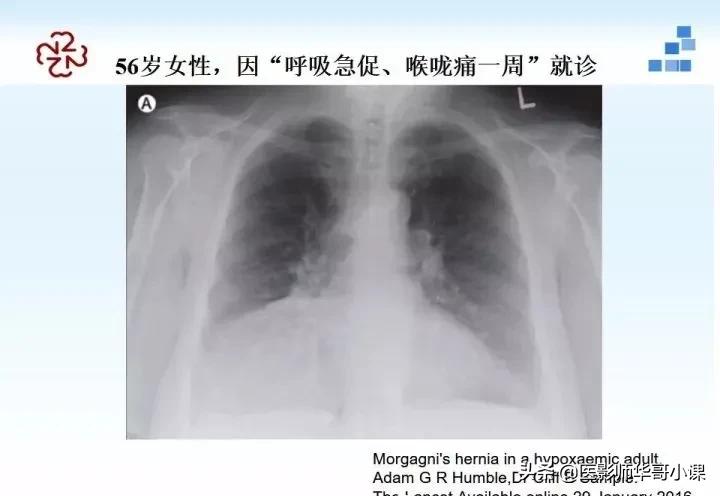 「精品课件」胸部膈肌的解剖及常见病变影像的表现