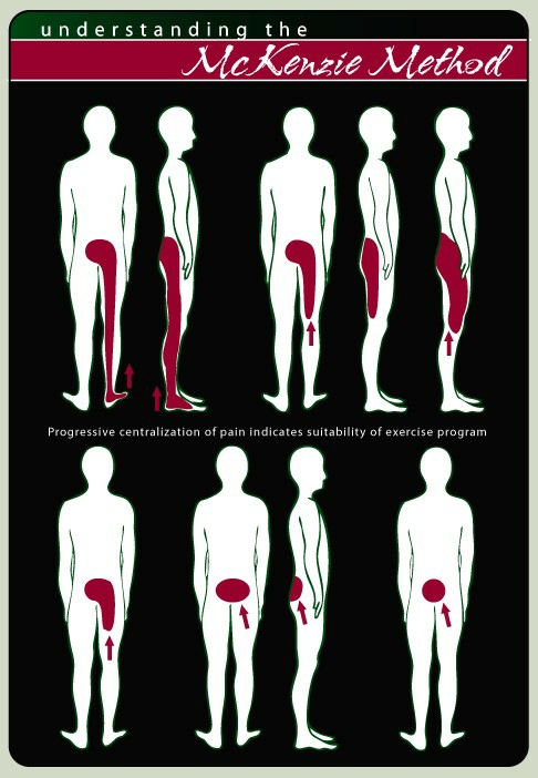 mckenzie运动,mckenzie治疗腰椎间盘突出