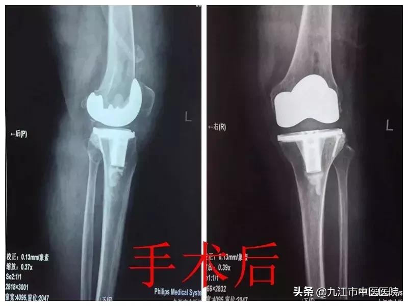 膝外翻畸形,膝外翻畸形伴屈曲畸形