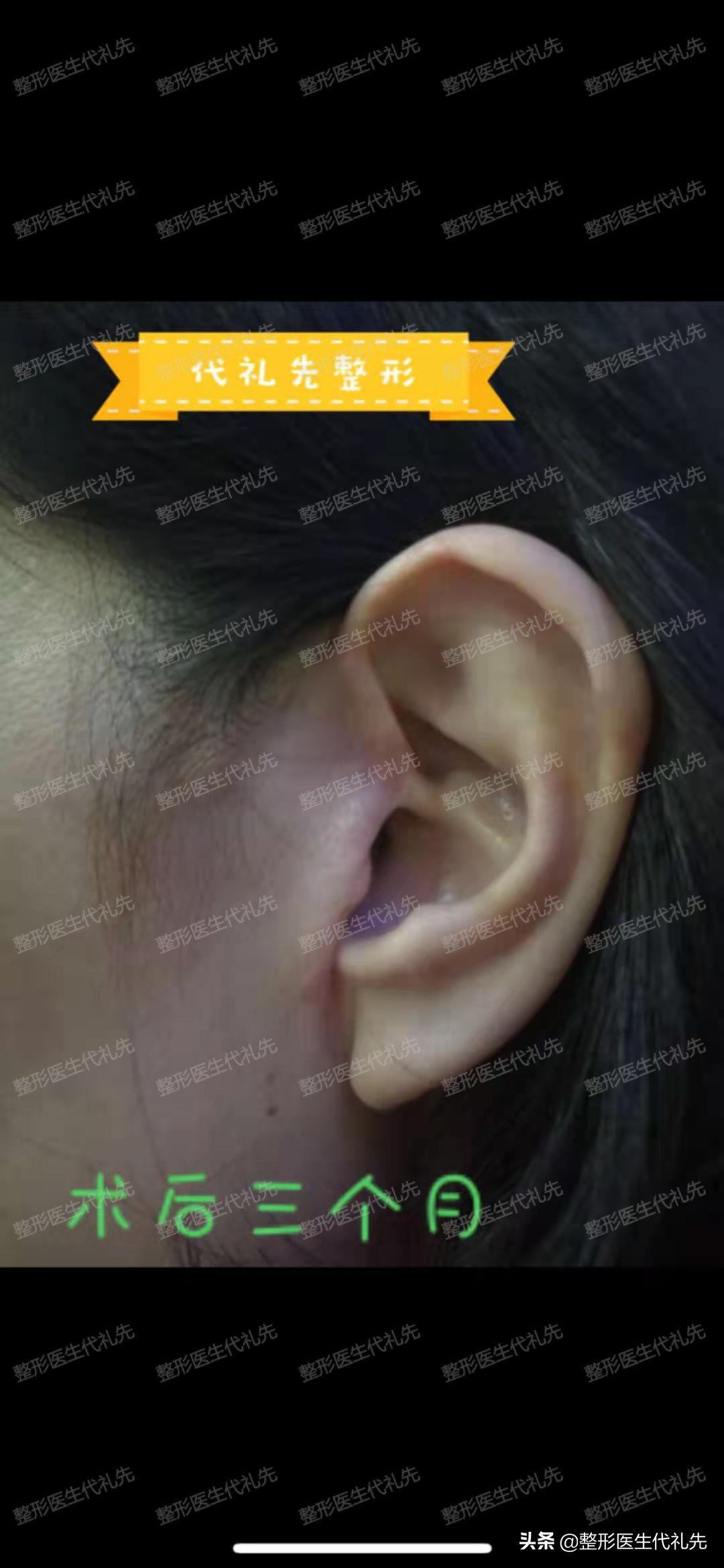 面部切皮提升手术,面部筋膜提升术和大拉皮