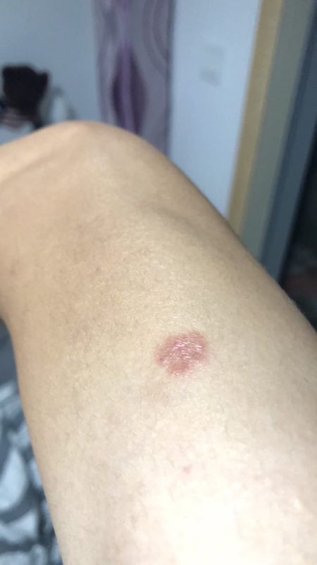 贪便宜花800元买了只蓝猫，一身猫癣还传染给了自己（真实案例）