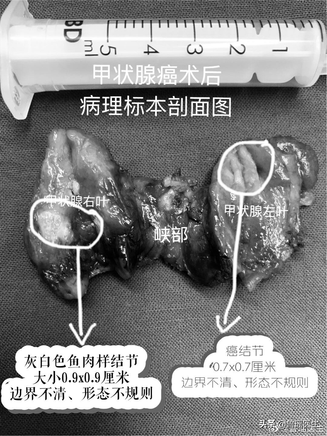 穿刺提示甲状腺癌就要做手术吗,甲状腺癌穿刺疑是恶性