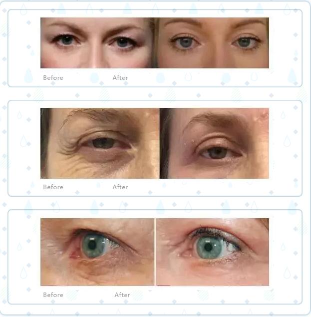 普丽施等离子仪多少钱一台,普丽施等离子