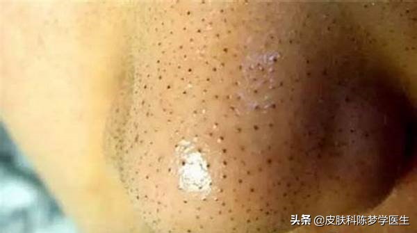 青春痘首选治疗方案是什么？答案都在这里了