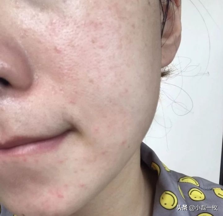 真正有效的祛痘印产品推荐,有什么很好的祛痘印产品