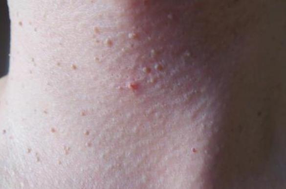 脖子上长的小肉粒可以揪下来吗,脖子腋下长小肉粒可以用手揪掉吗