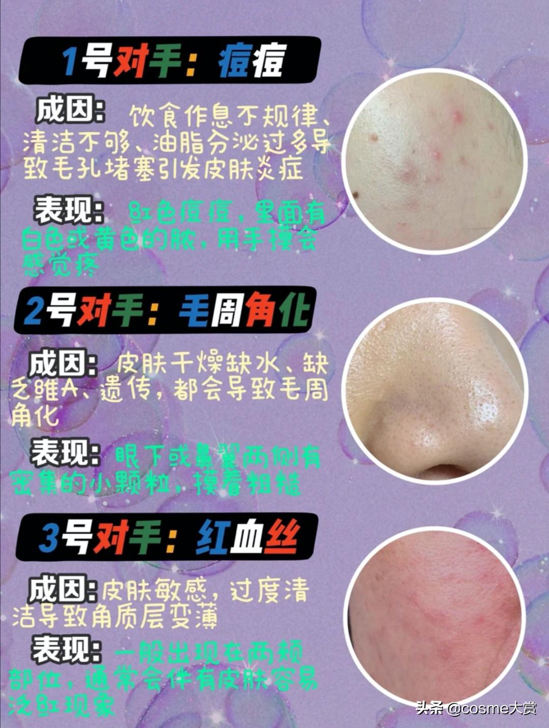 脸上粉刺闭口痘印瑕疵用什么,皮肤暗黄粗糙瑕疵痘痘闭口